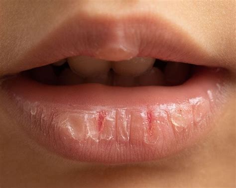 An oral mucocele or mucous cyst is a harmless, fluid-filled bump inside the mouth. It’s often caused by trauma or salivary gland blockage and is the most common noncancerous salivary gland lesion. Mucoceles can develop anywhere on the buccal mucosa. This area includes: The lower lip is the most typical site, usually due to lip …